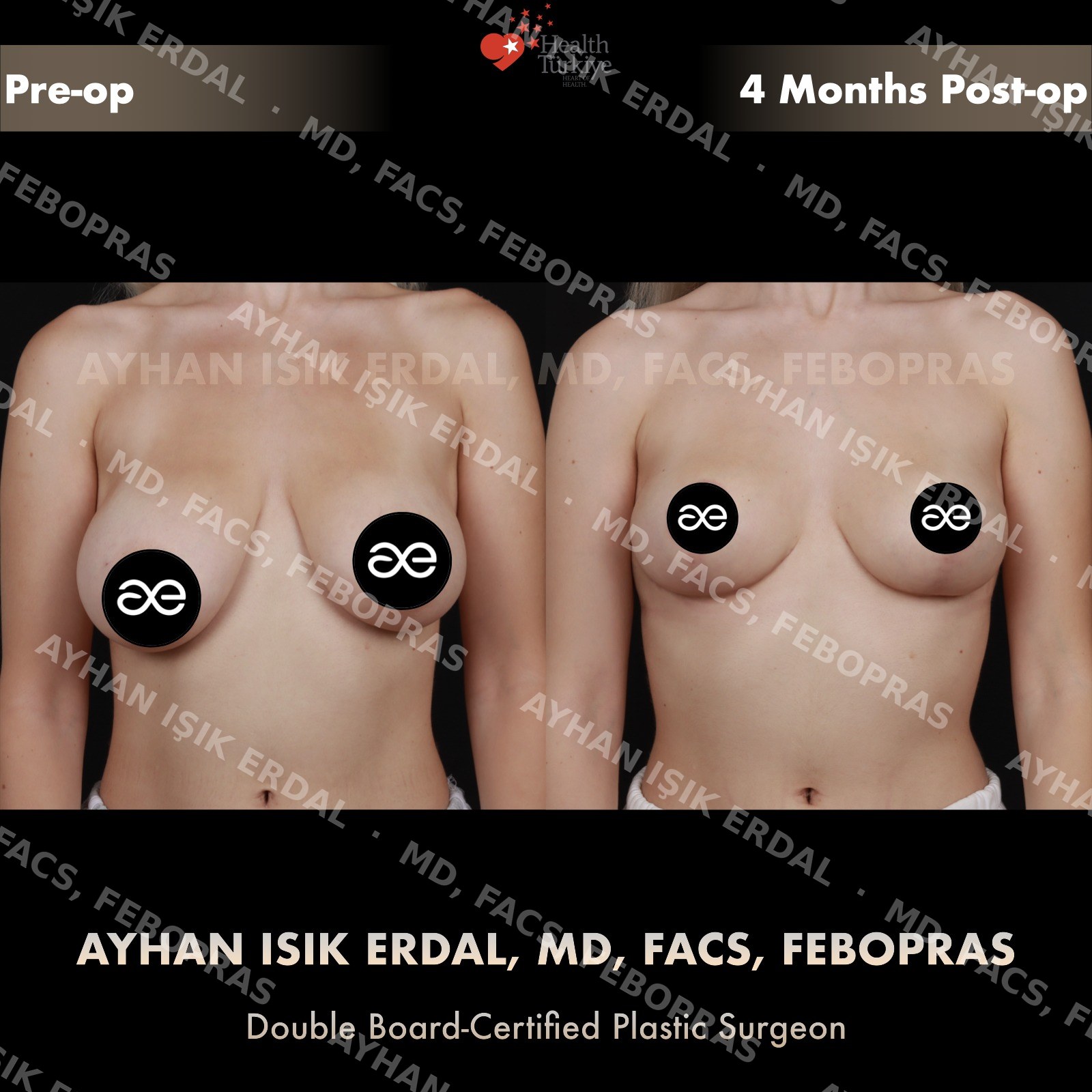 Breast lift before and after — autologous mastopexy, frontal view, 4 months post-op