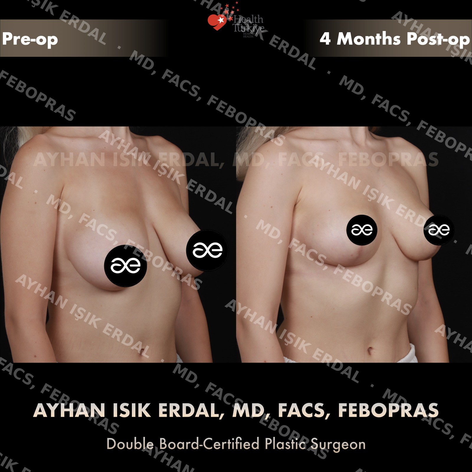 Breast lift before and after — autologous mastopexy, oblique view, 4 months post-op
