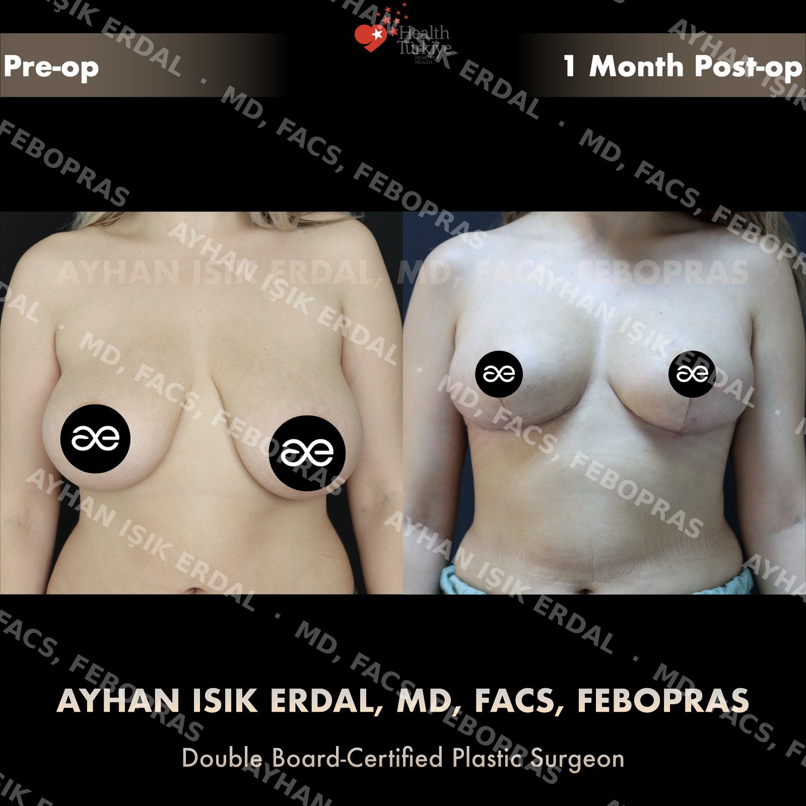Breast lift before and after — autologous mastopexy, frontal view, 1 month post-op