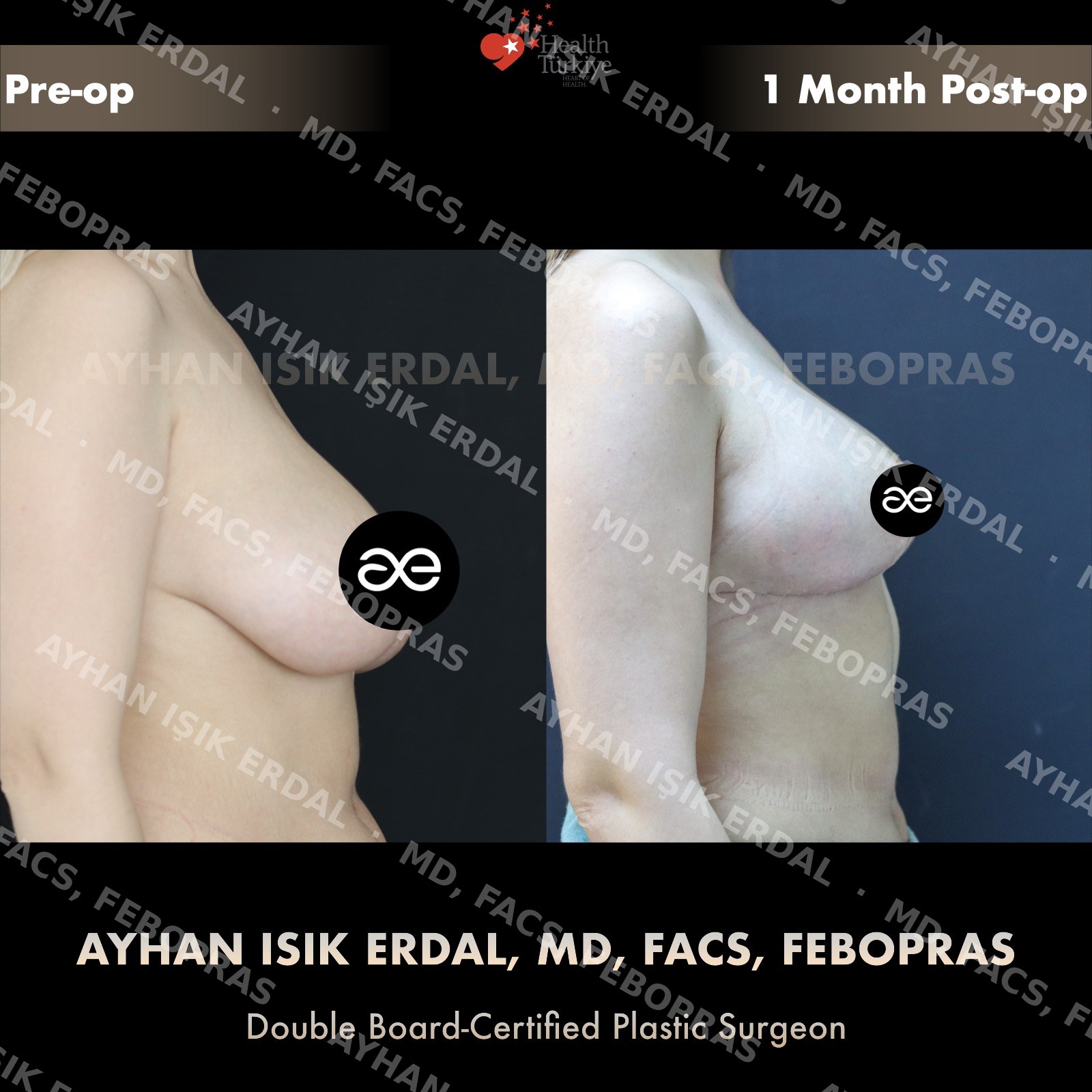 Breast lift before and after — autologous mastopexy, lateral view, 1 month post-op