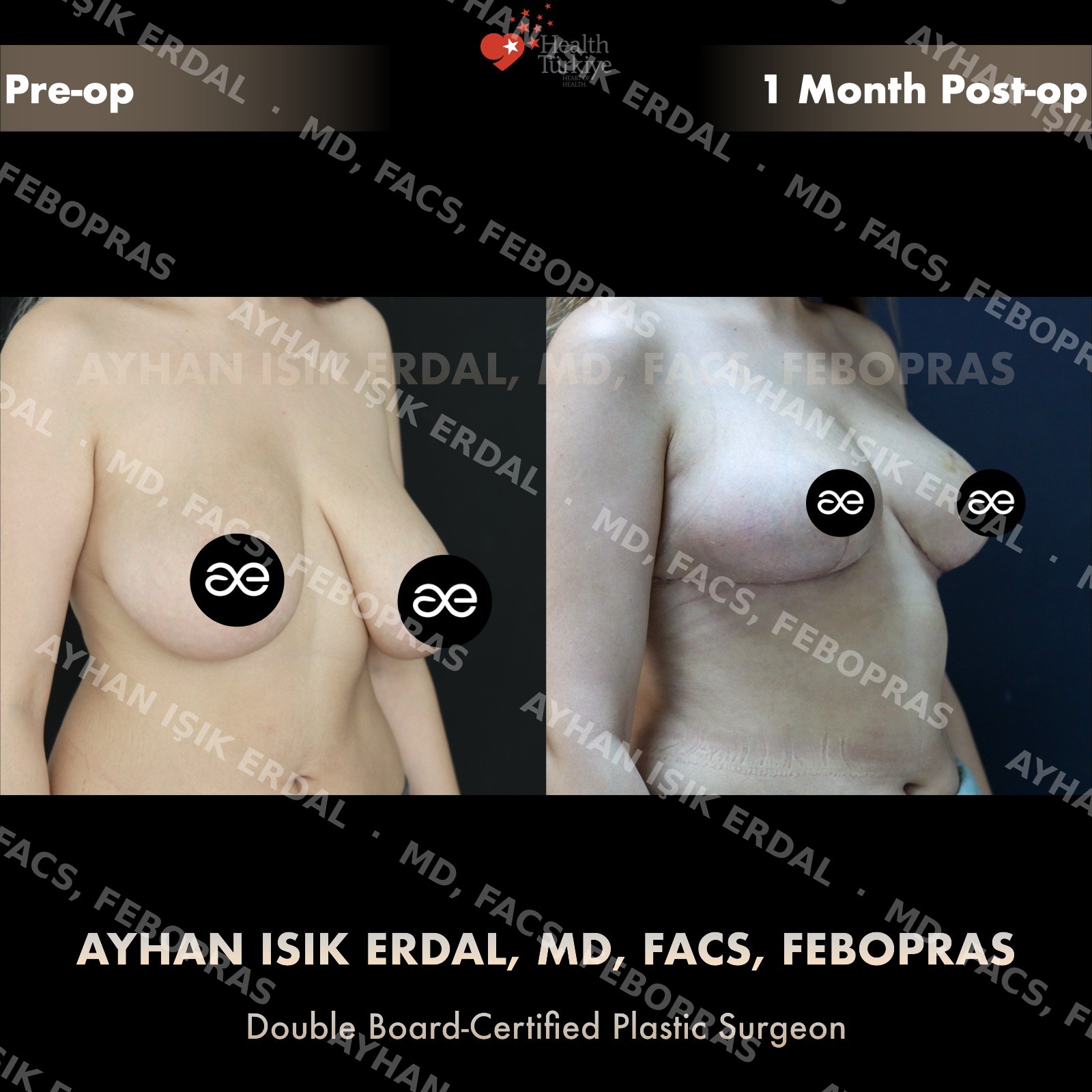 Breast lift before and after — autologous mastopexy, oblique view, 1 month post-op