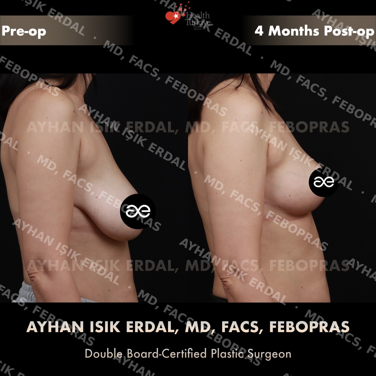 Breast lift before and after — autologous mastopexy, lateral view, 4 months post-op