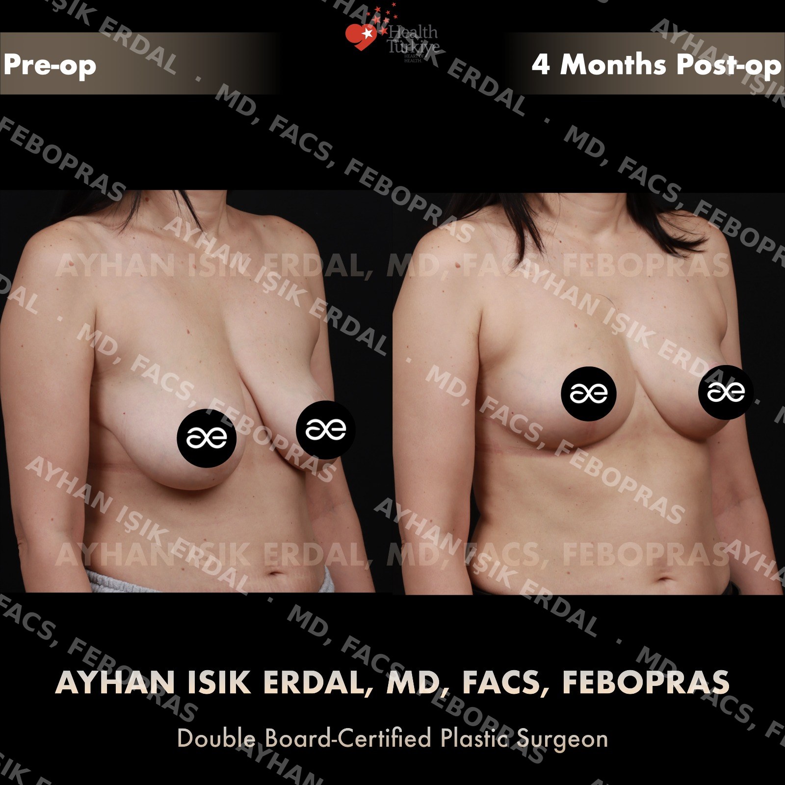 Breast lift before and after — autologous mastopexy, oblique view, 4 months post-op