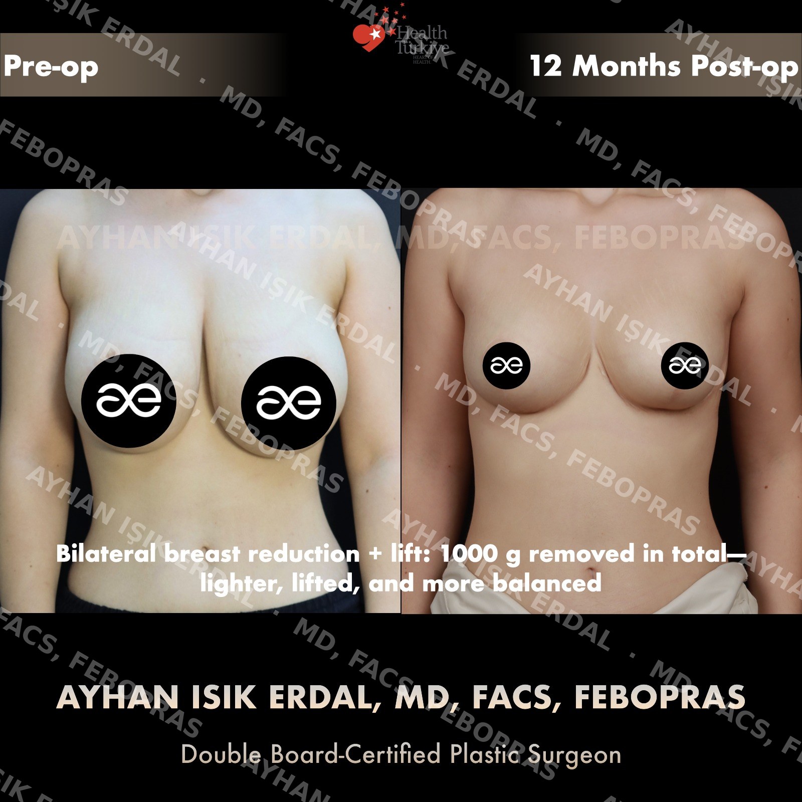 Breast lift before and after — autologous reduction-mastopexy, frontal view, 12 months post-op (fully matured scar)