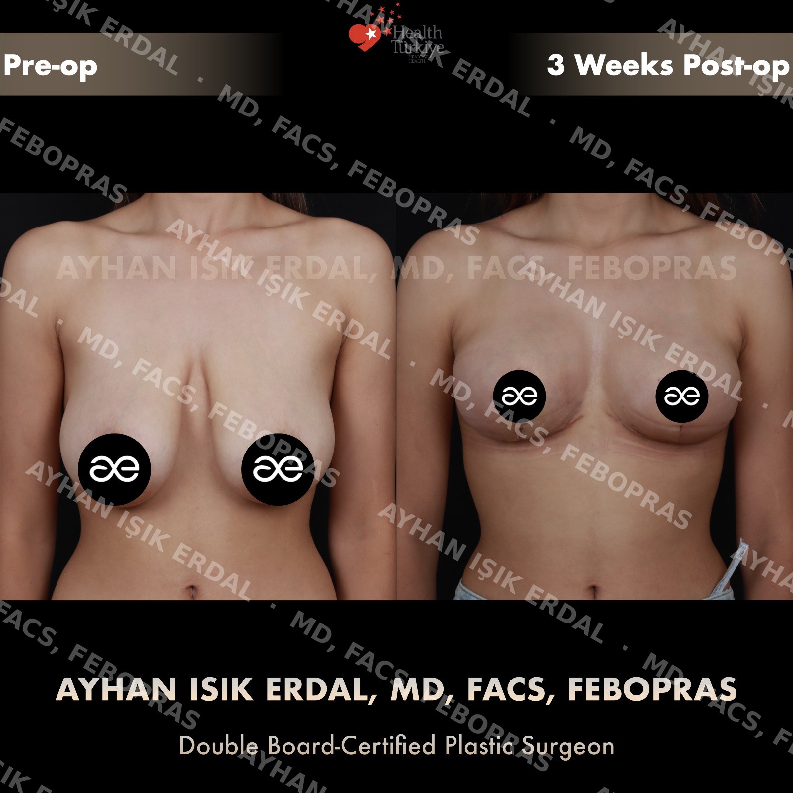 Breast lift before and after — autologous mastopexy, frontal view, 3 weeks post-op (early healing)