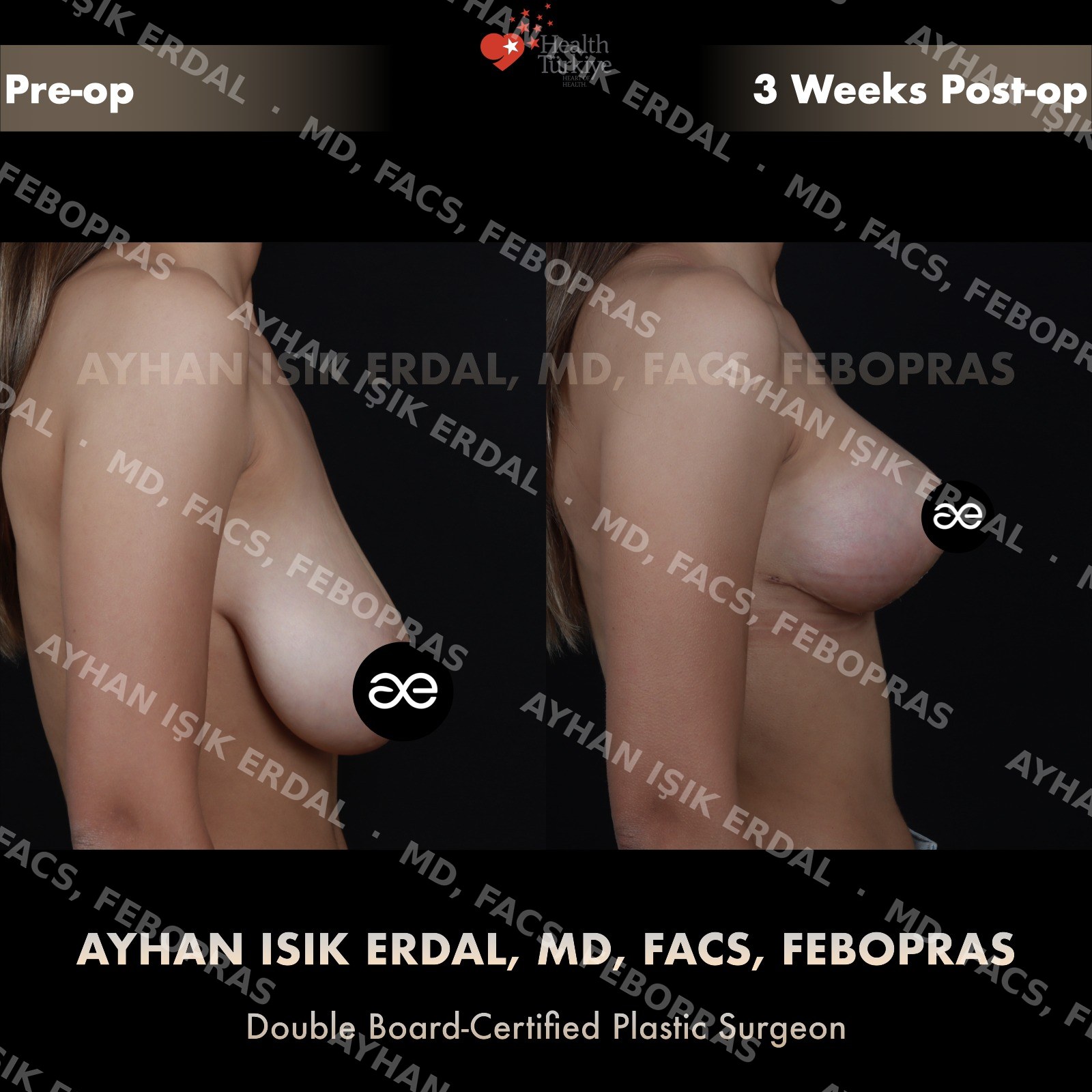 Breast lift before and after — autologous mastopexy, lateral view, 3 weeks post-op