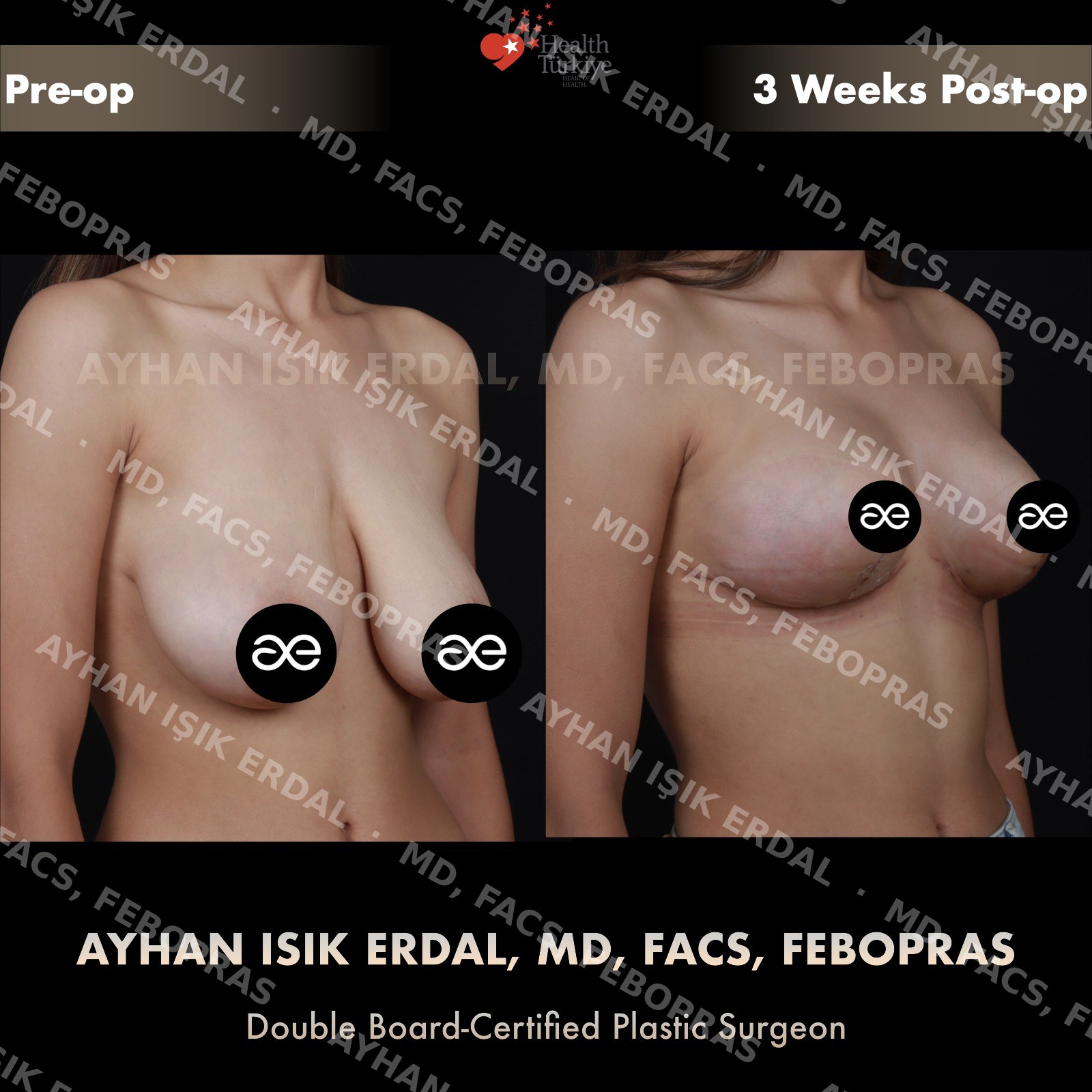 Breast lift before and after — autologous mastopexy, oblique view, 3 weeks post-op