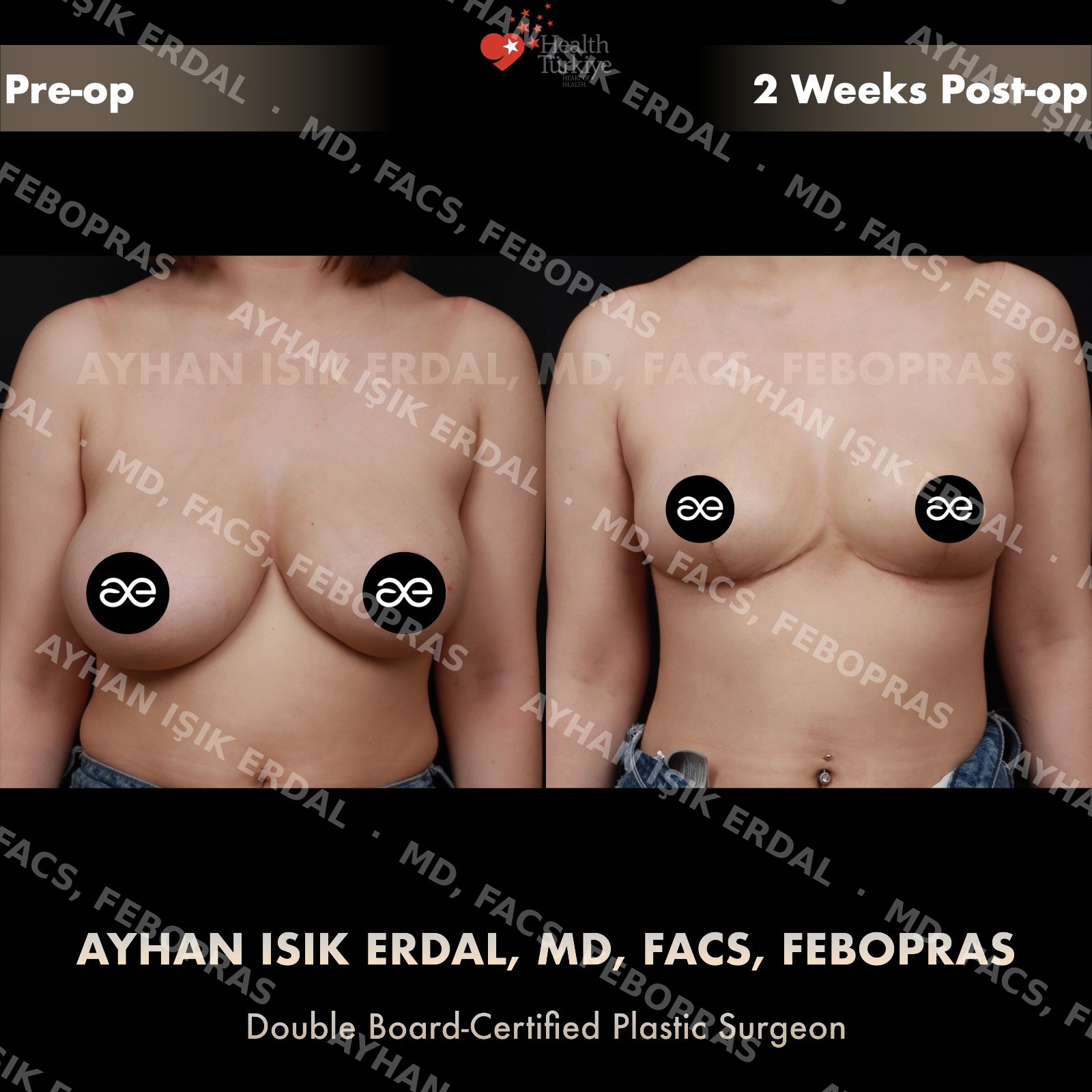Breast lift before and after — autologous mastopexy, frontal view, 2 weeks post-op (early healing)