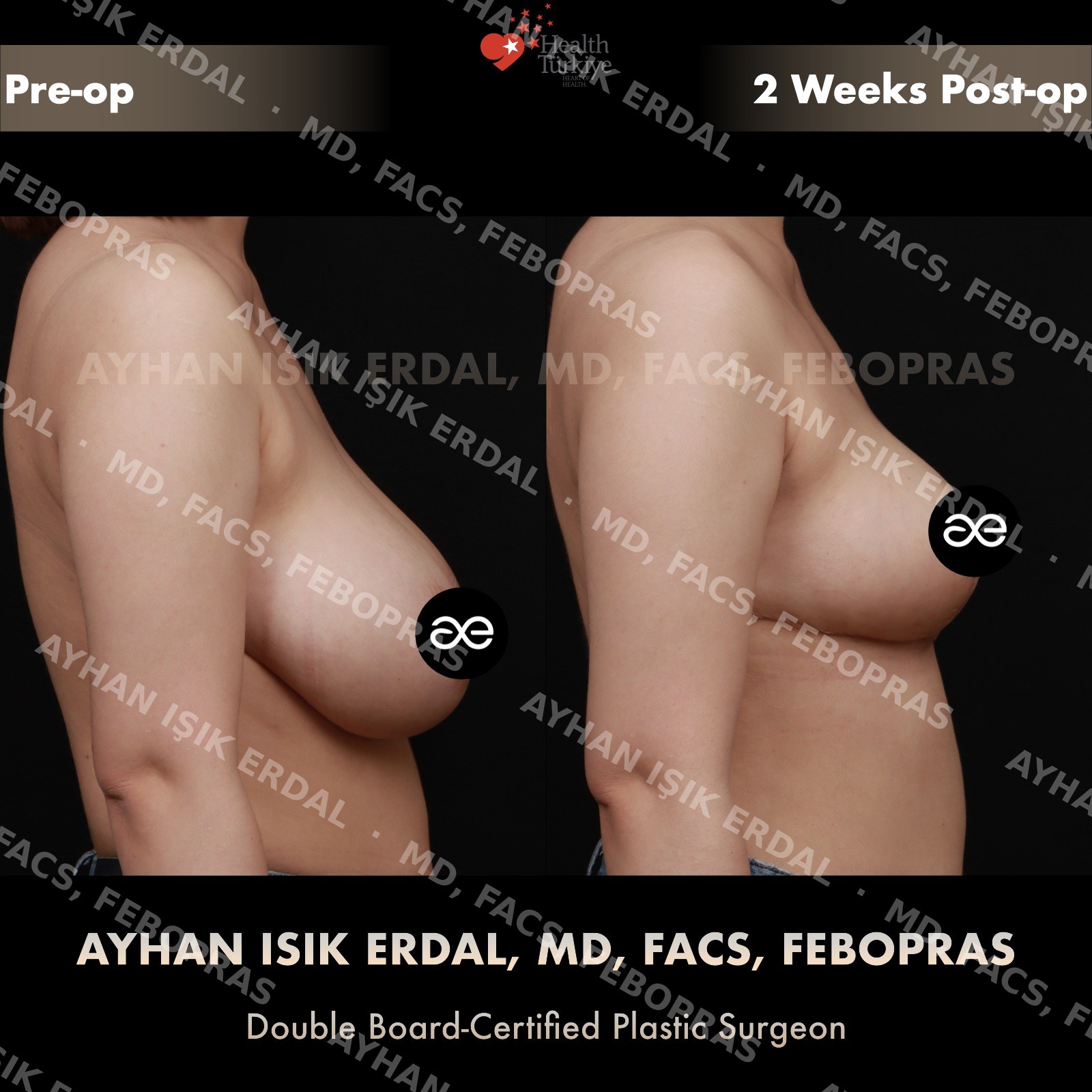 Breast lift before and after — autologous mastopexy, lateral view, 2 weeks post-op