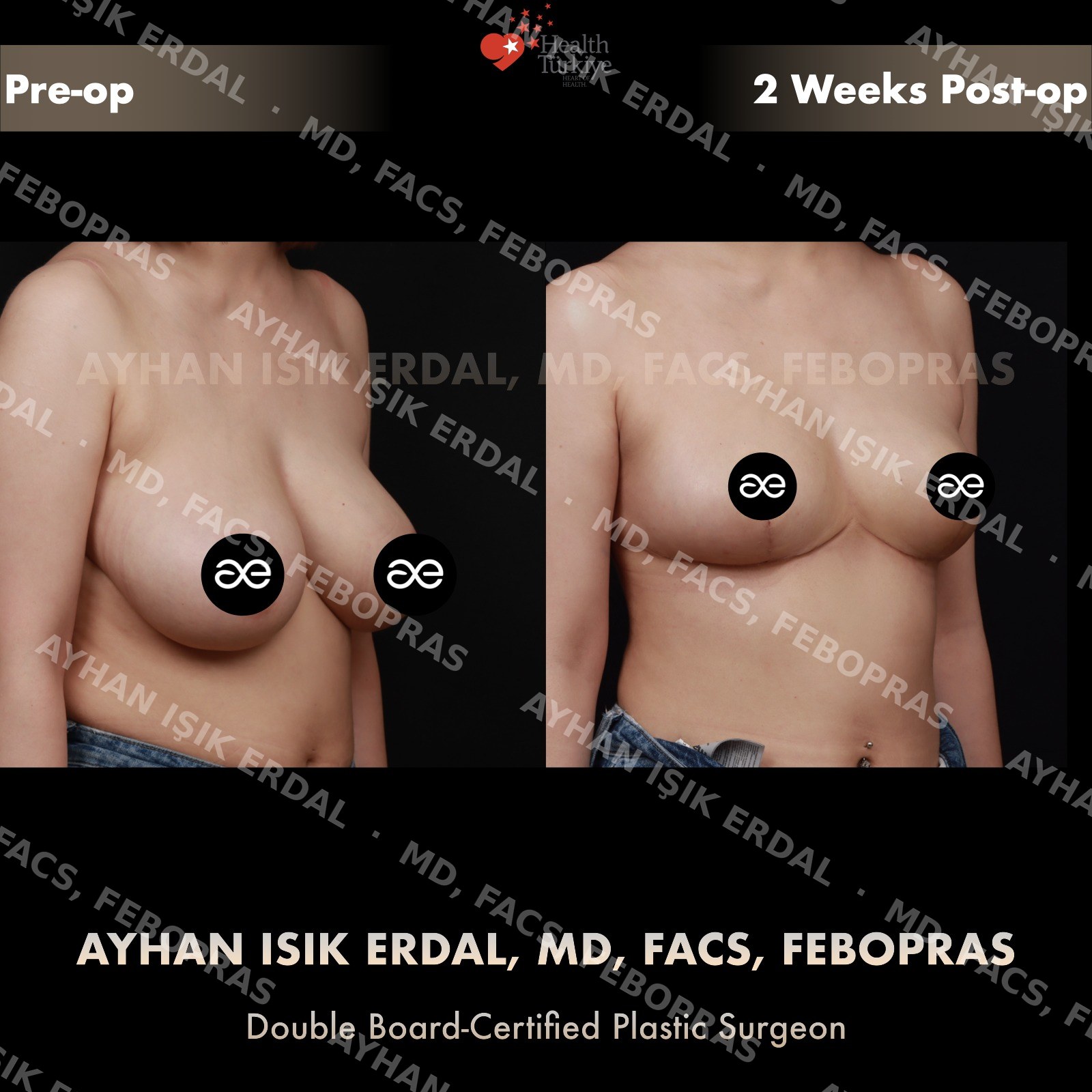 Breast lift before and after — autologous mastopexy, oblique view, 2 weeks post-op