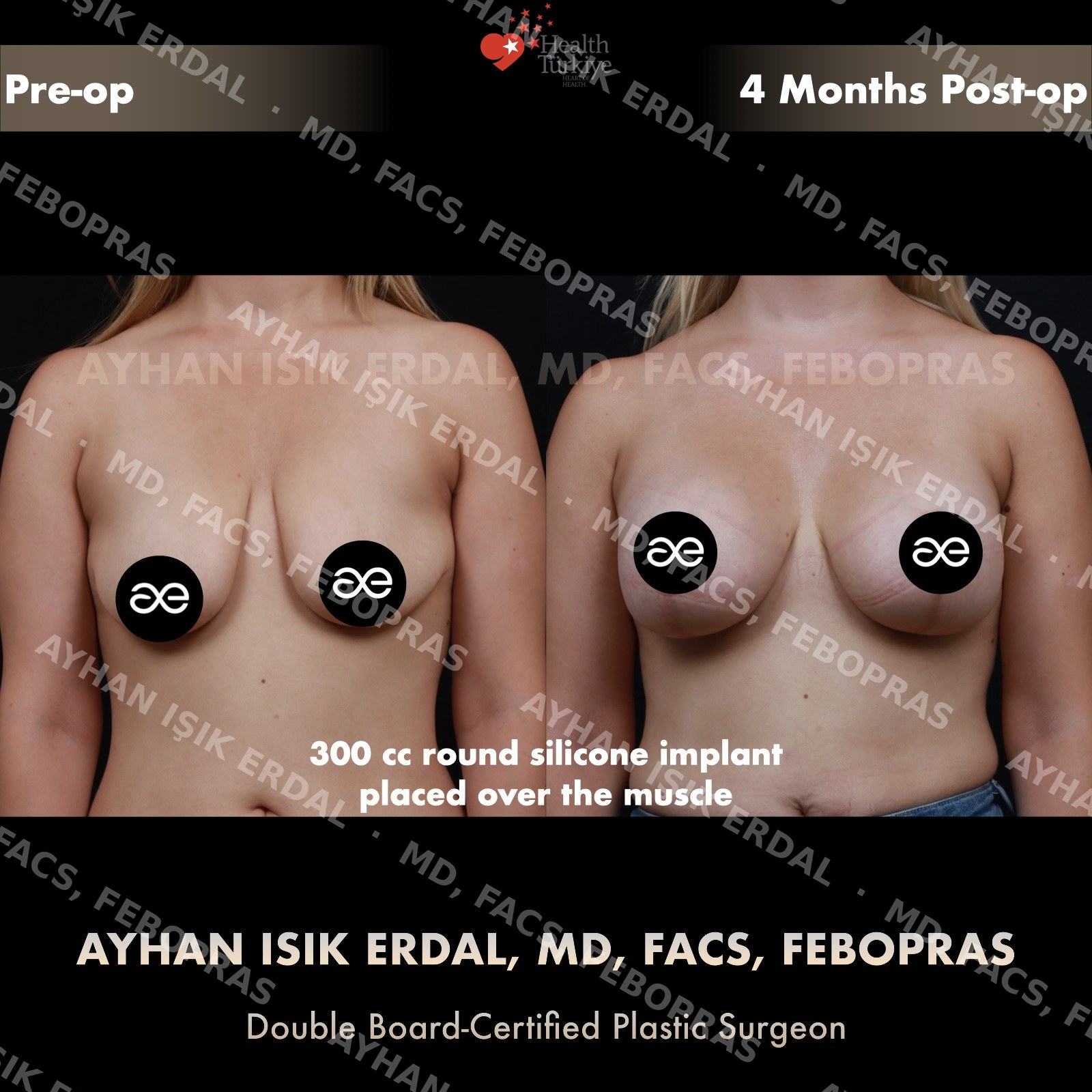 Breast lift with 300cc round silicone implant placed over the muscle, frontal view, 4 months post-op