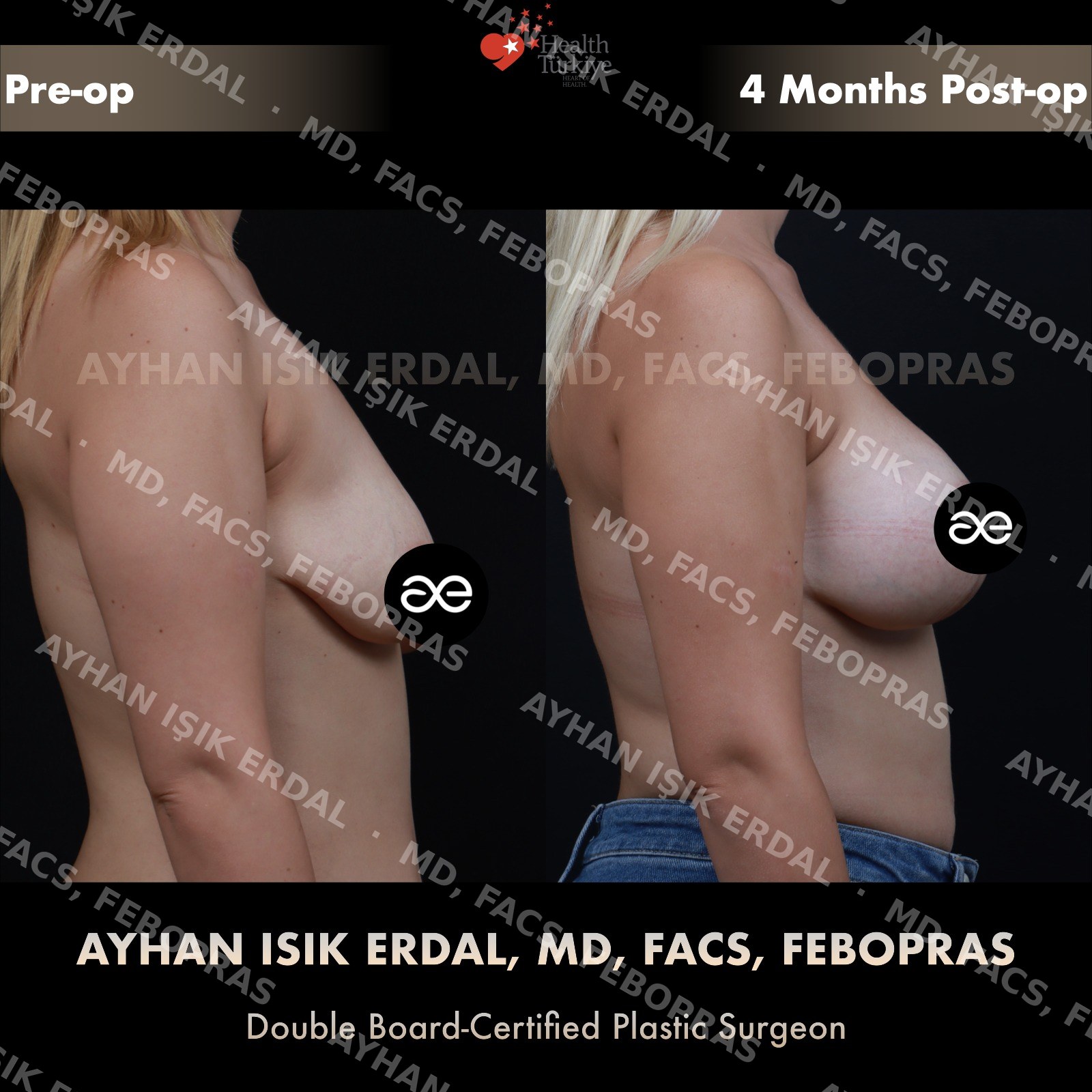 Breast lift with 300cc round silicone implant placed over the muscle, lateral view, 4 months post-op