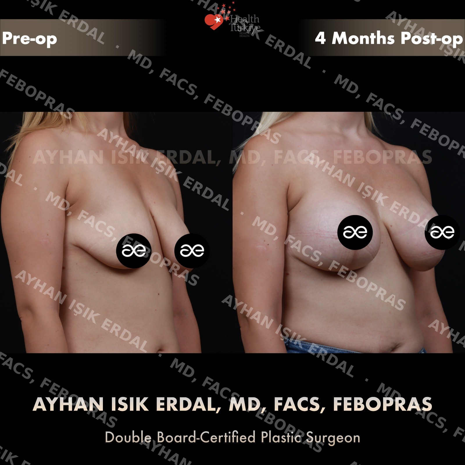 Breast lift with 300cc round silicone implant placed over the muscle, oblique view, 4 months post-op