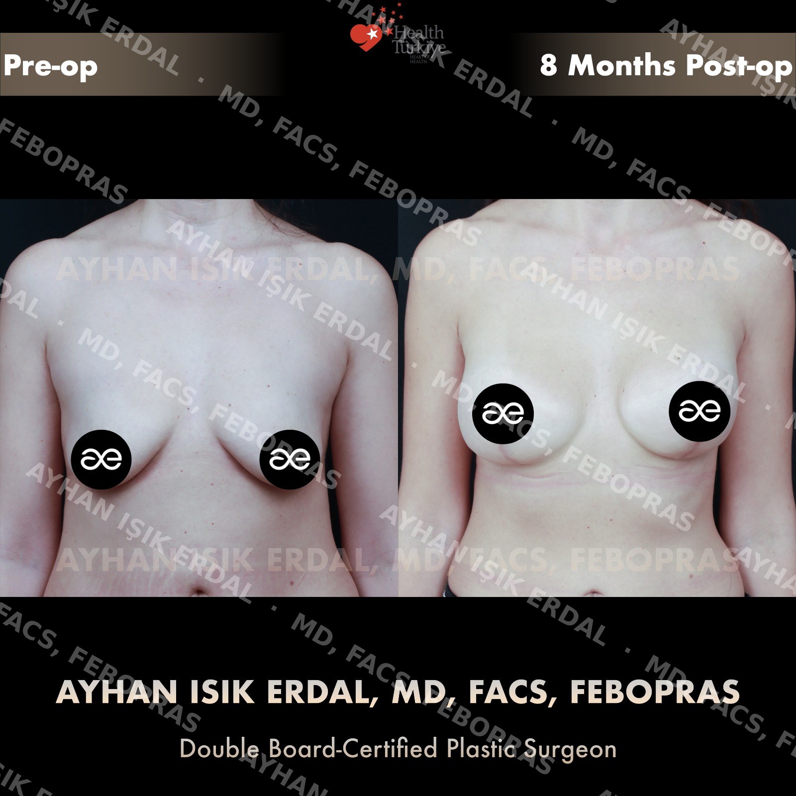 Augmentation-mastopexy with round implant, frontal view, 8 months post-op (mature result)