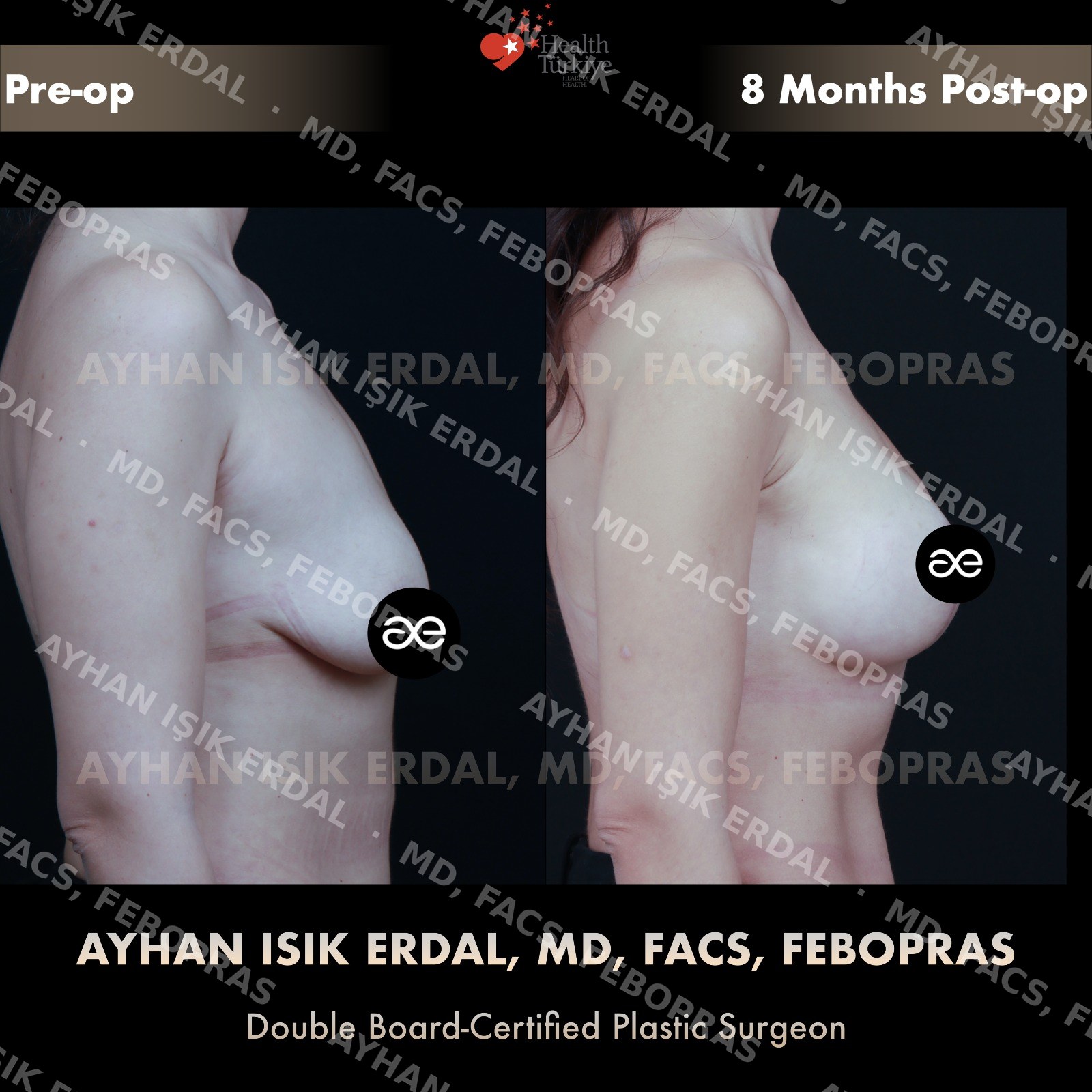 Augmentation-mastopexy with round implant, lateral view, 8 months post-op