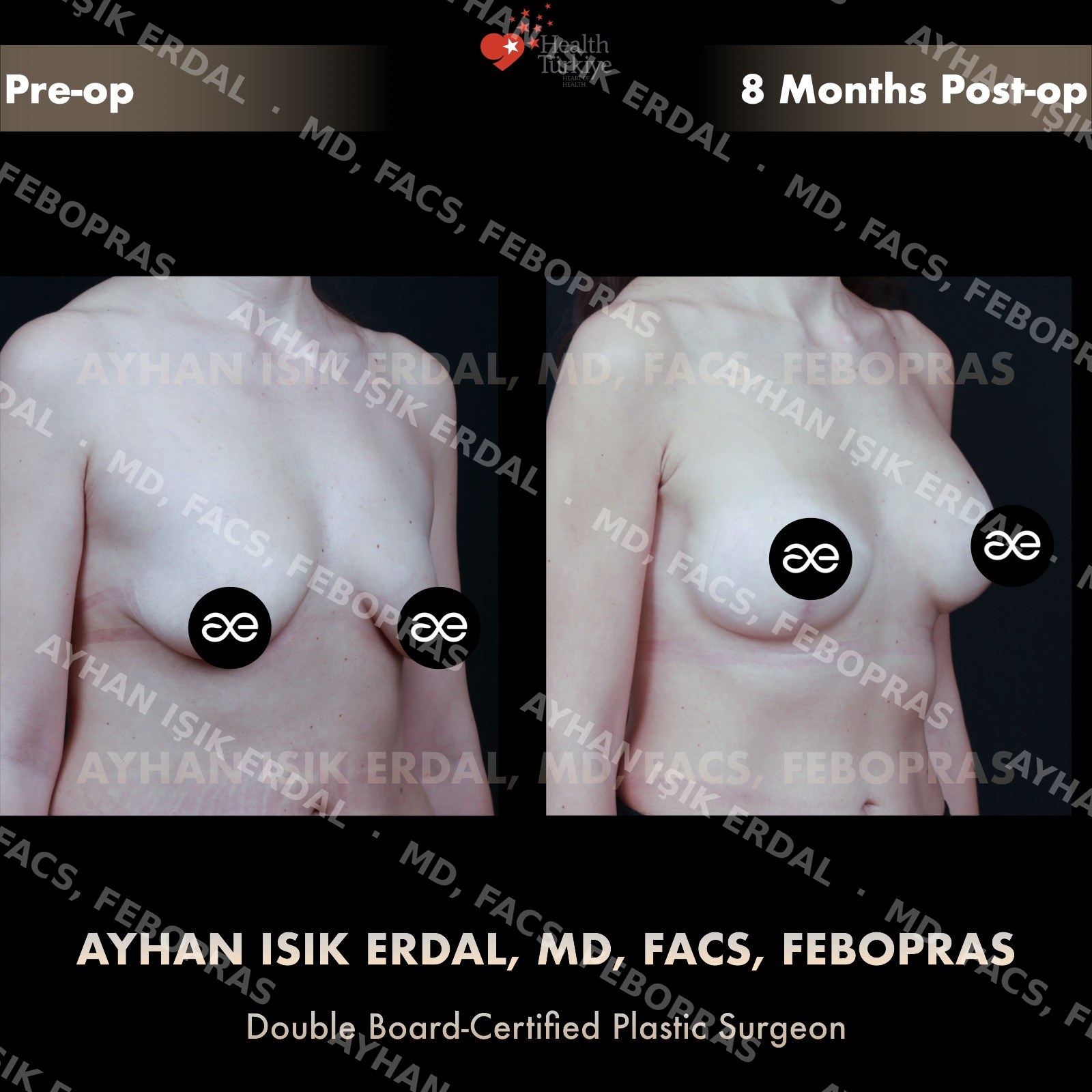 Augmentation-mastopexy with round implant, oblique view, 8 months post-op