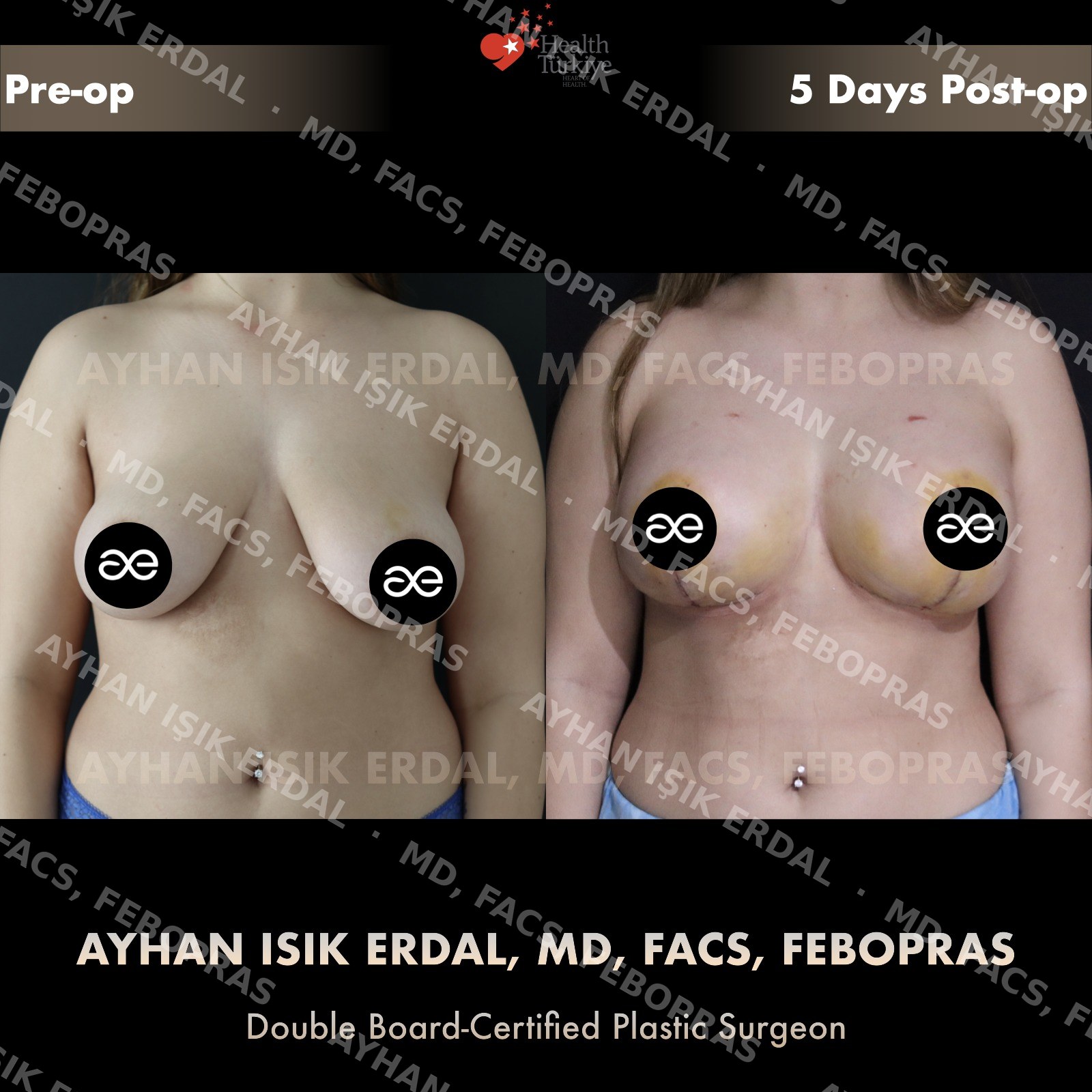Augmentation-mastopexy with round implant, frontal view, 5 days post-op (very early healing)