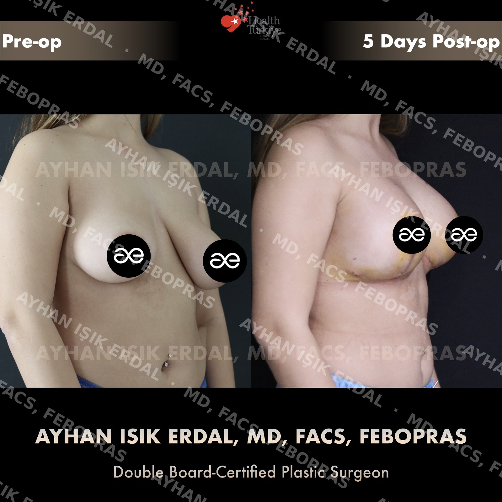 Augmentation-mastopexy with round implant, oblique view, 5 days post-op